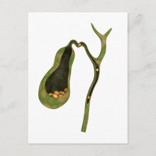 Conceptual Image Of Gallstones Inside Gall Postcard