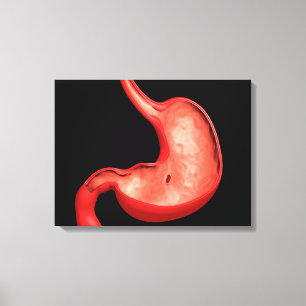 Conceptual Image Of Peptic Ulcer In Stomach Canvas Print