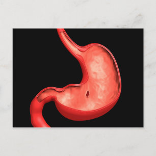 Conceptual Image Of Peptic Ulcer In Stomach Postcard
