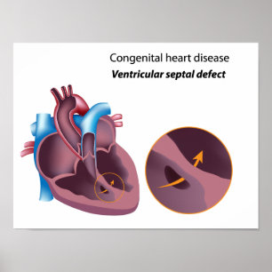 Congenital heart disease  Poster