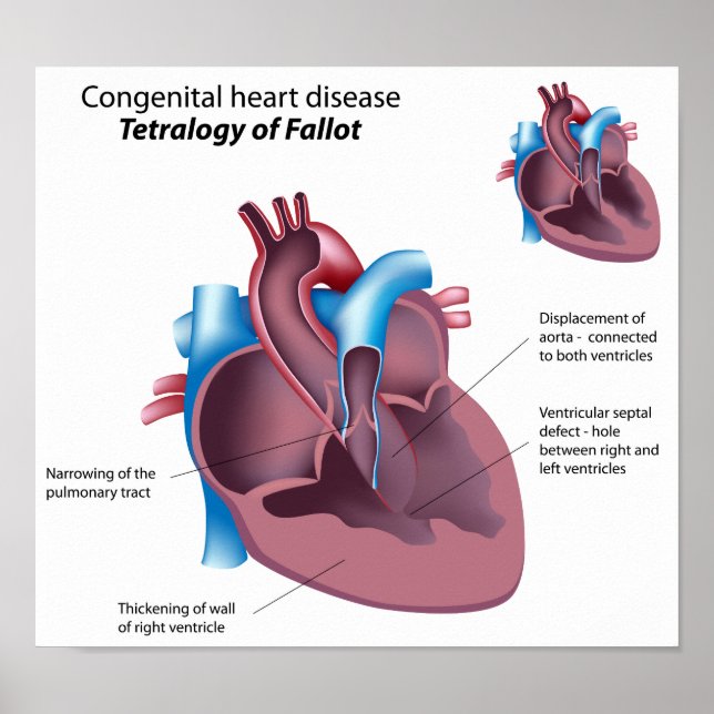Congenital heart disease Poster (Front)