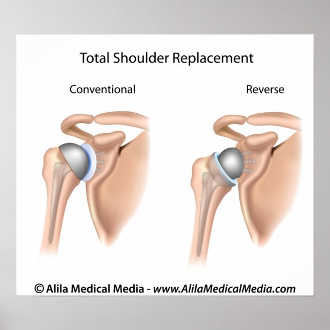 Conventional vs reverse total shoulder replacement poster (Front)
