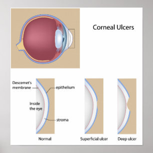 Corneal ulcer eye condition Poster