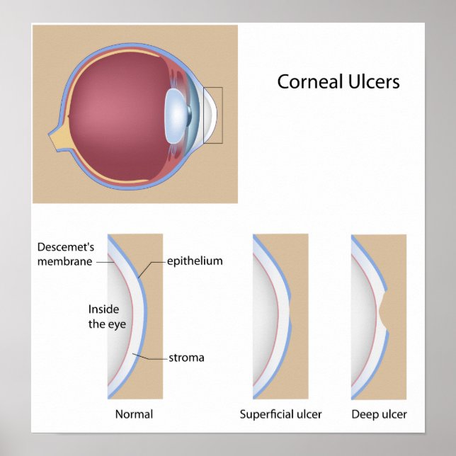 Corneal ulcer eye condition Poster (Front)