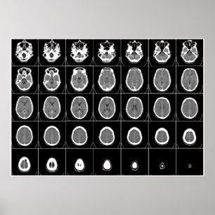 CT SCAN of HEAD Poster