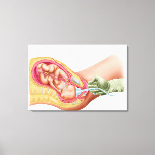 Delivery Of Foetus Using Vacuum Extraction Canvas Print