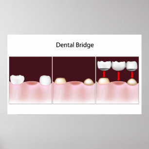 Dental bridge procedure Poster