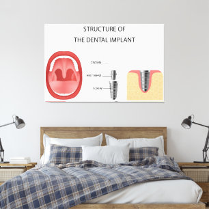 Dental implant structure canvas print