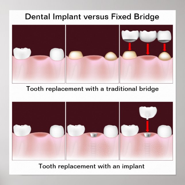 Dental implant versus bridge Poster (Front)