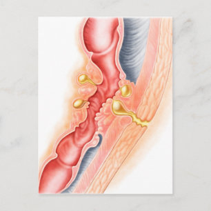 Development Of Fistula Postcard