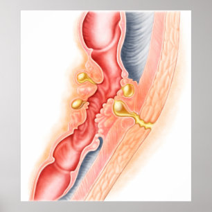 Development Of Fistula Poster