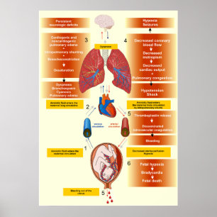 Diagram of an Amniotic Fluid Embolism Poster