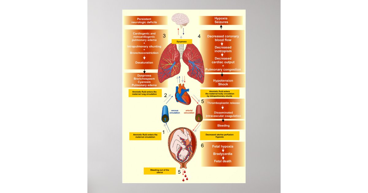 Diagram of an Amniotic Fluid Embolism Poster Zazzle.co.uk