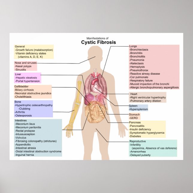 Diagram of the Manifestations of Cystic Fibrosis Poster (Front)