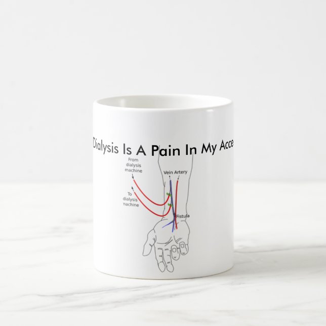 Dialysis Is A Pain In My Access Coffee Mug (Center)