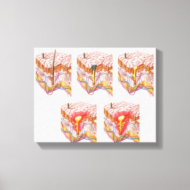 Different Types Of Acne Canvas Print (Front)