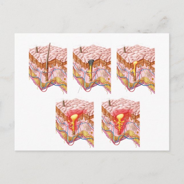 Different Types Of Acne Postcard (Front)