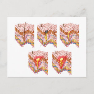 Different Types Of Acne Postcard
