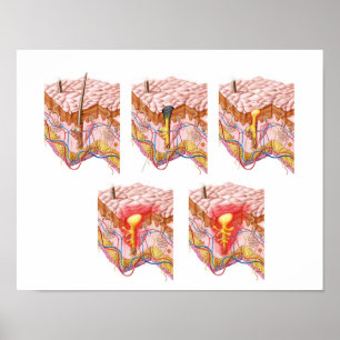 Different Types Of Acne Poster