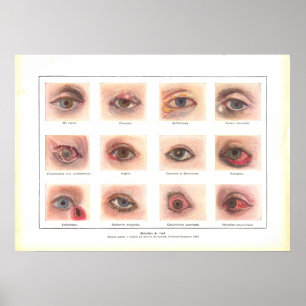 Diseases of Eye Anatomy Poster French