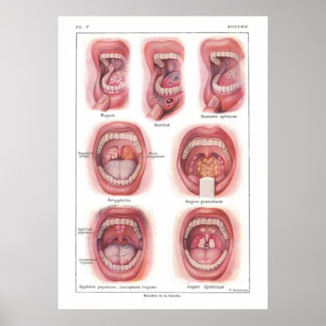 Diseases of Mouth Anatomy Poster French (Front)