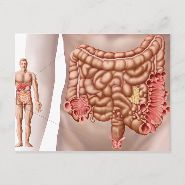 Diverticulitis In The Descending Colon Region Postcard (Front)