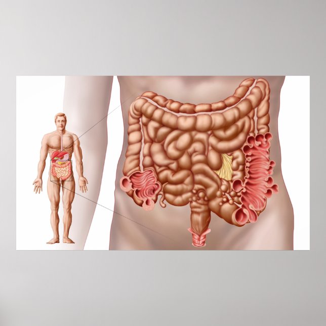 Diverticulitis In The Descending Colon Region Poster (Front)