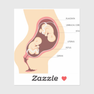 Dizygotic twin pregnancy