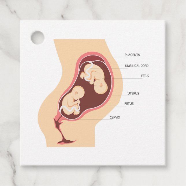 Dizygotic twin pregnancy favour tags (Front)