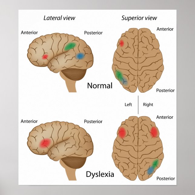 Dyslexia brain activity Poster (Front)