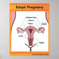 Ectopic Pregnancy