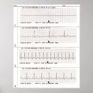 ekg Rhythms Poster