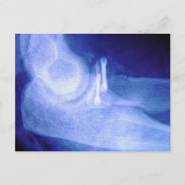 Elbow xray with screws postcard (Front)