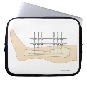 External Fixator Laptop Sleeve