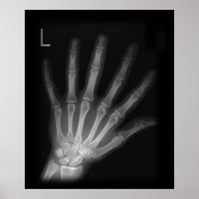 Extra Digit X-ray Left Hand Poster (Front)
