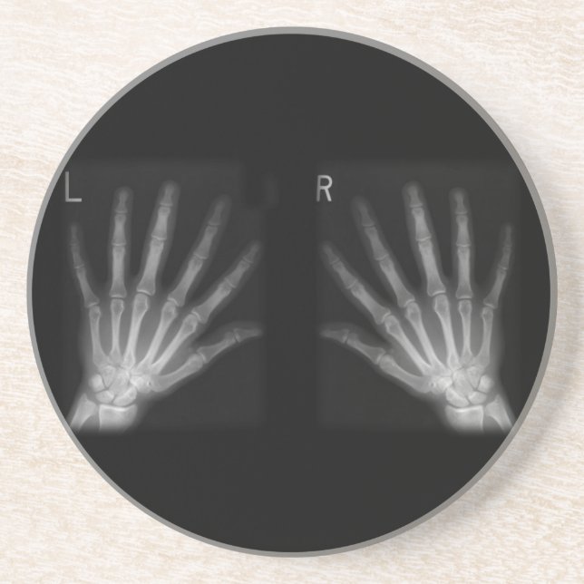 Extra Digit X-ray Right & Left Hands Coaster (Front)