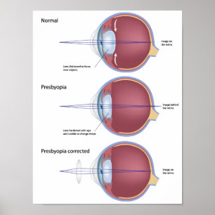 Eye defect presbyopia Poster