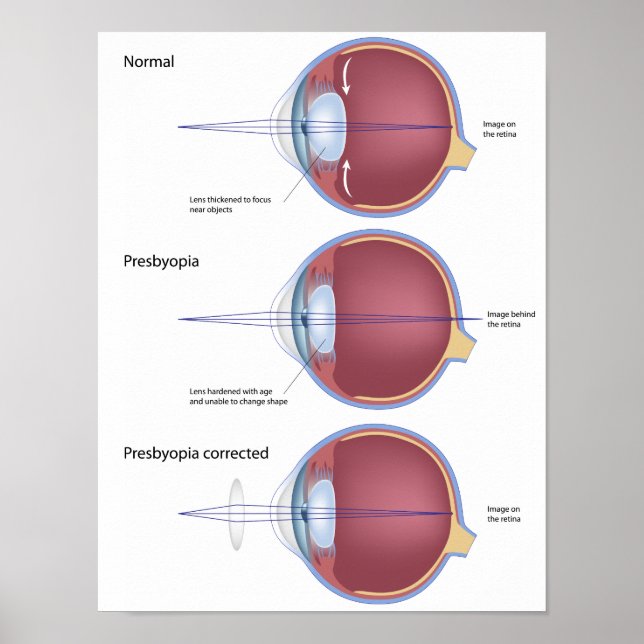 Eye defect presbyopia Poster (Front)