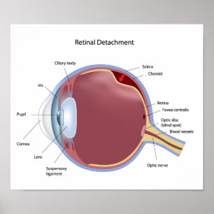 Eye retinal detachment  Poster