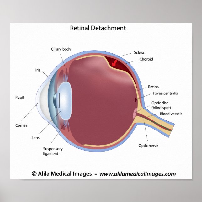 Eye retinal detachment  Poster (Front)