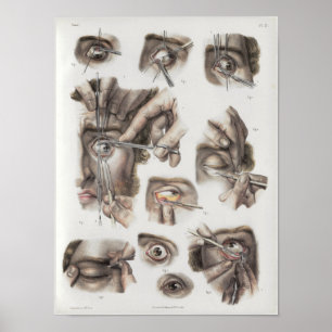Eye Surgery Technique Vintage Anatomy Print