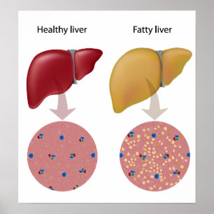 Fatty liver disease Poster