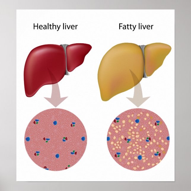 Fatty liver disease Poster (Front)