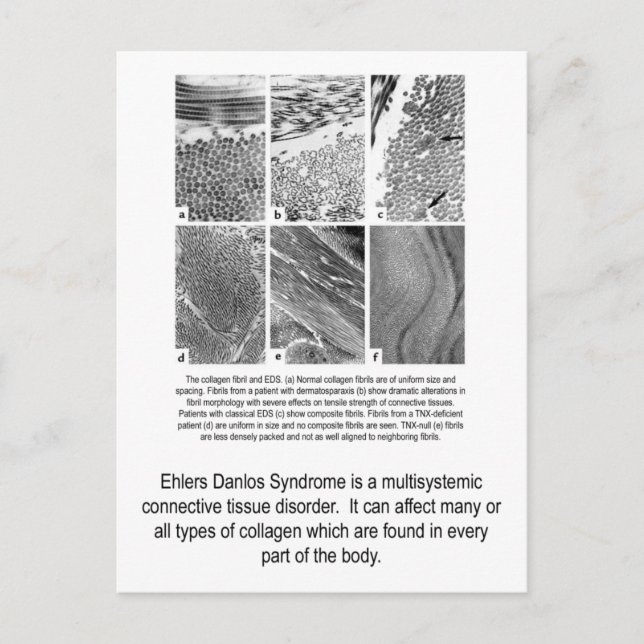 Faulty Collagen EDS Awareness Postcard (Front)