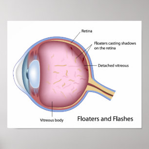 Floaters and Flashes eye disease Poster