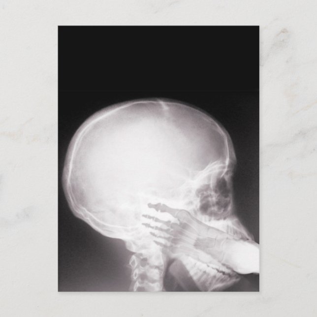 Foot in Mouth X-Ray Postcard (Front)