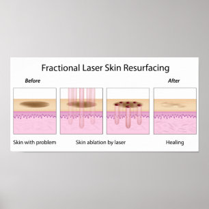Fractional Laser Skin Resurfacing Poster