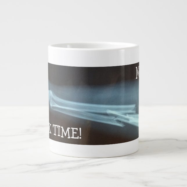 Fractured Radius and Ulna Xray "Break Time" Large Coffee Mug (Front)