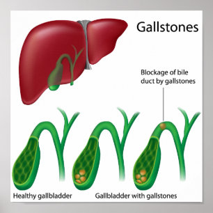 Gallstones and Liver Poster