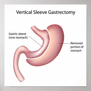 Gastric sleeve weight loss surgery Poster